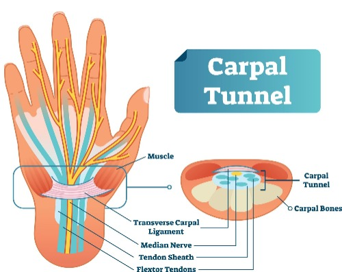 Carpal tunnel physio Carpal tunnel physio