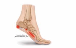 Heel Pain Physio