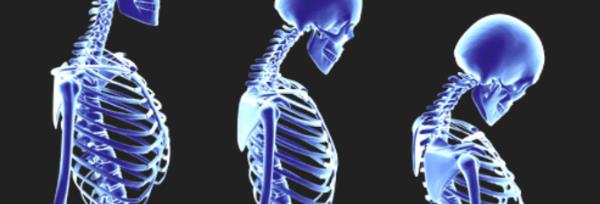 Physio for Osteoporosis Physio for Osteoporosis