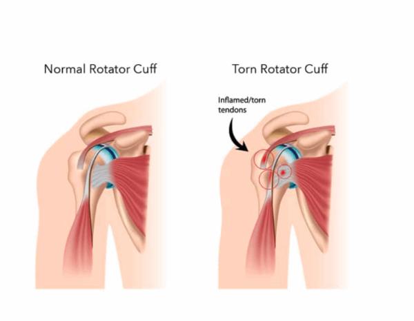 Rotator Cuff tear Rotator Cuff tear