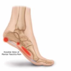 Plantar Fasciitis