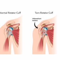 Rotator Cuff Pain